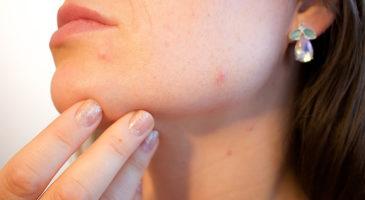 Pimples and Acne removal using Natural remedies